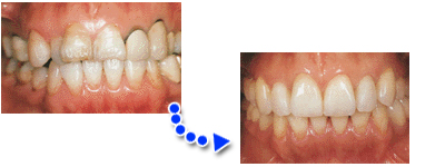 �_�C���N�g�{���f�B���O